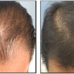 کوکتل مزولایک هیرمن