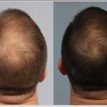 کوکتل مزولایک هیرمن